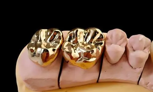 Full Cast Metal Crowns Provide Long-Term Reliability in Challenging Dental Cases